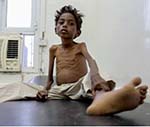 سازمان ملل:  ۲۰ میلیون انسان را گرسنگی تهدید می کند